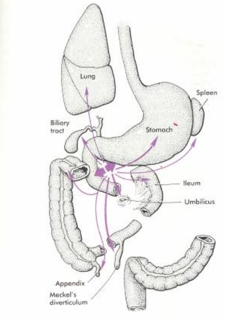 related keywords amp suggestions for ectopic pancreas related keywords amp suggestions for ectopic pancreas