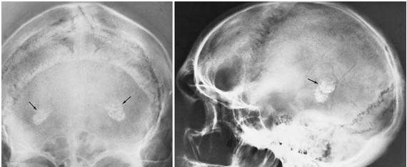 Atlas Of Normal Roentgen Variants That May Simulate Disease Pdf