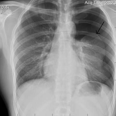 Aspects radiologiques pneumologie - Memrise