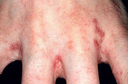 7 year itch scabies