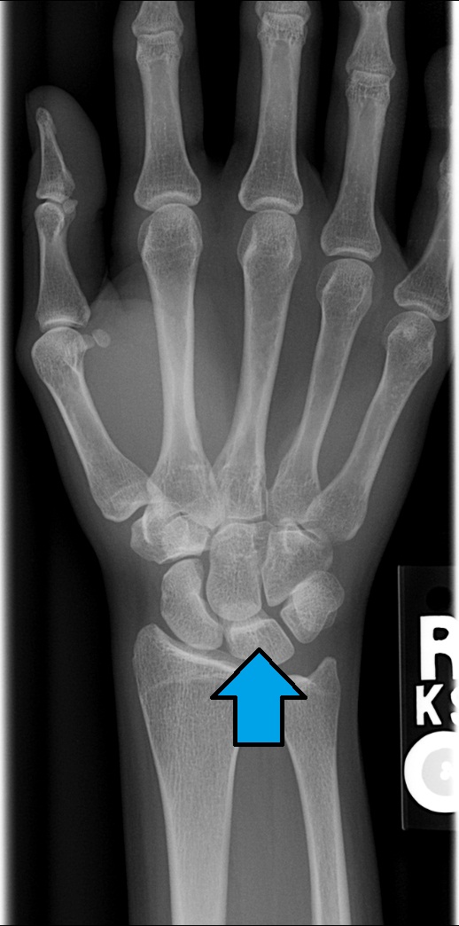 Level 1 - Carpal & Tarsal Bones - Memrise