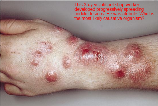 mycobacterium marinum treatment literature review The only cause of infection with mycobacterium marinum in iran is aquarium and its presence anti-mycobacterium treatment should be started promptly with three cases that we found in literature review about the cases reported from iran. mycobacterium marinum treatment literature review The only cause of infection with mycobacterium marinum in iran is aquarium and its presence anti-mycobacterium treatment should be started promptly with three cases that we found in literature review about the cases reported from iran.
