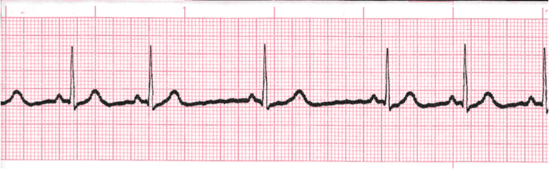 Level 2 - ECG - Memrise