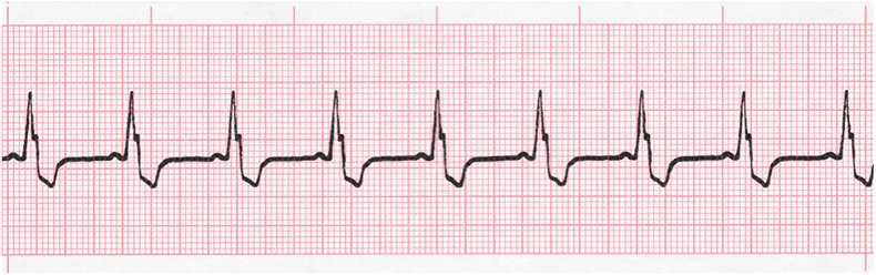 Level 2 - ECG - Memrise