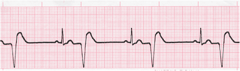 Level 2 - ECG, - Memrise