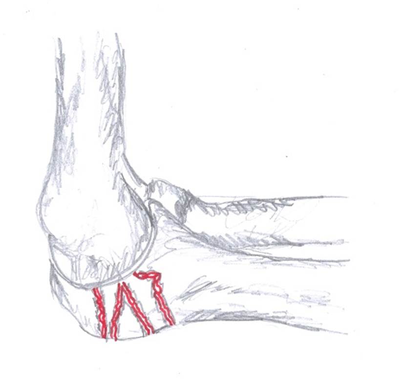 Level 6 Mayo Fracture Classification Olecranon Elbow Anatomy and