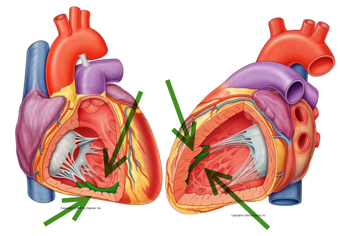 Левый желудочек сердца гипертрофирован. Диагональная трабекула левого желудочка что это. Дополнительная хорда левого желудочка. Диагональная трабекула левого желудочка что это. Дополнительная трабекула левого желудочка.